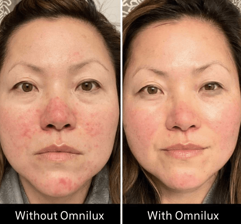 Omnilux Omnilux Contour Face