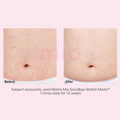 Mama Mio Goodbye Stretch Marks Stretch Mark Minimiser (100ml)