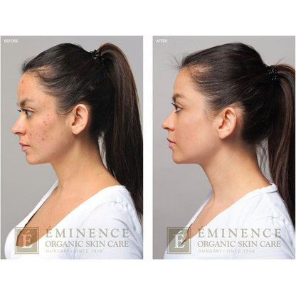 Eminence Acne Advanced 3 Step Treatment System