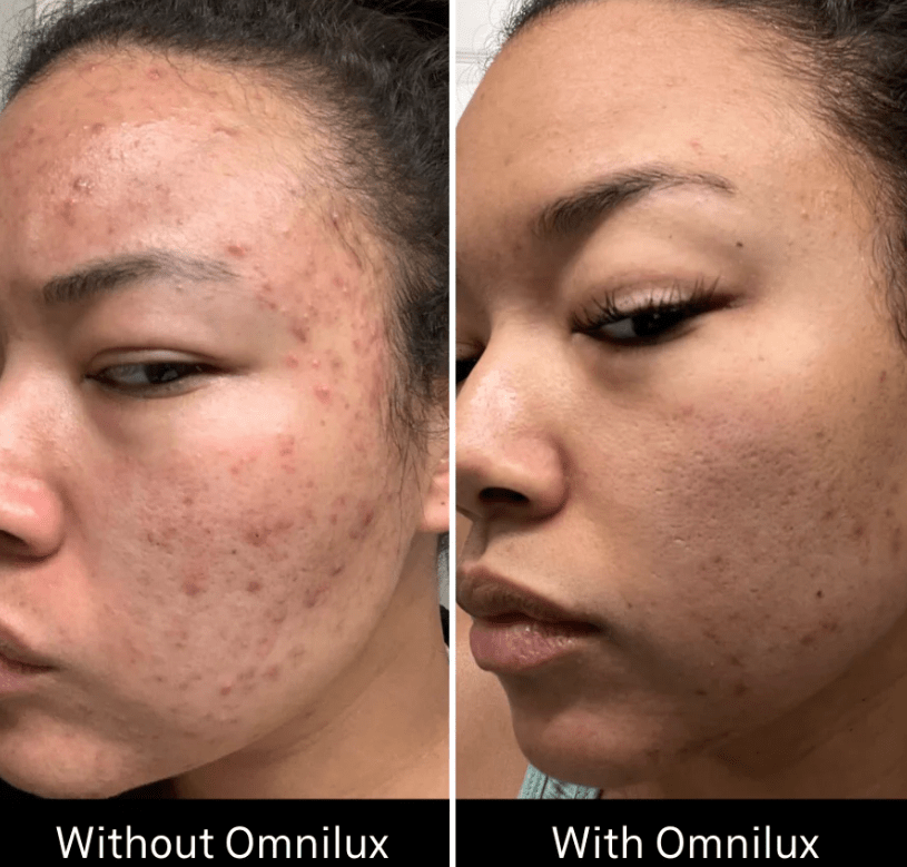 Omnilux Omnilux Clear LED Light Therapy