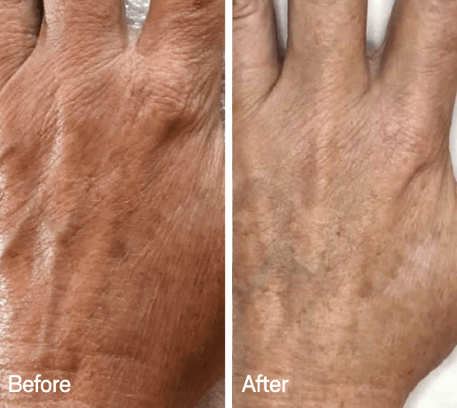 Omnilux Omnilux Contour Glove LED Light Therapy