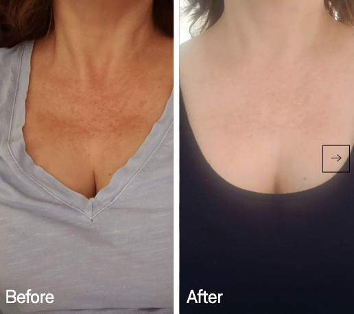 Omnilux Omnilux Contour Neck & Décolleté LED Light Therapy