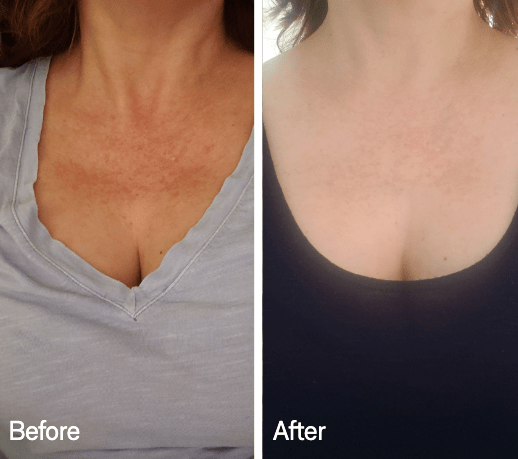 Omnilux Omnilux Contour Neck & Décolleté LED Light Therapy