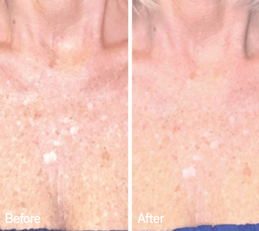 Omnilux Omnilux Contour Neck & Décolleté LED Light Therapy